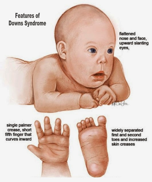 down syndrome screening labs